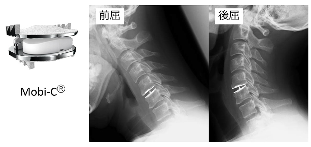 頚椎人工椎間板置換術